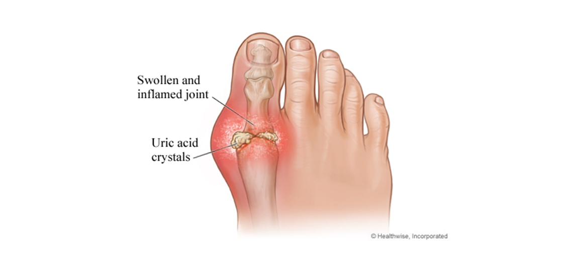 Gout and Pseudogout | BCM
